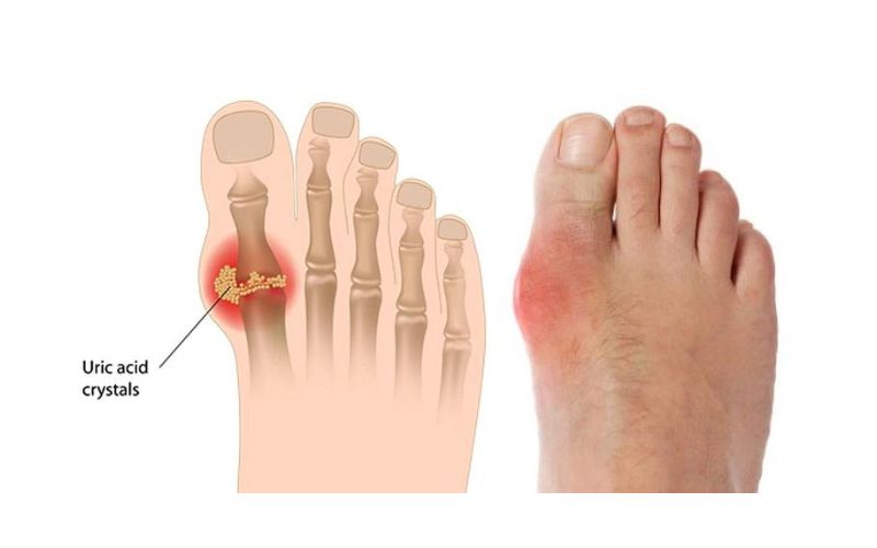 Bệnh gout là một loại viêm khớp hình thành do sự tích tụ quá mức axit uric trong cơ thể, dẫn đến sự hình thành tinh thể urat 