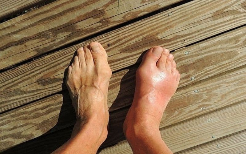 Bệnh gout có thể được phân loại dựa trên giai đoạn phát triển và nguyên nhân gây ra