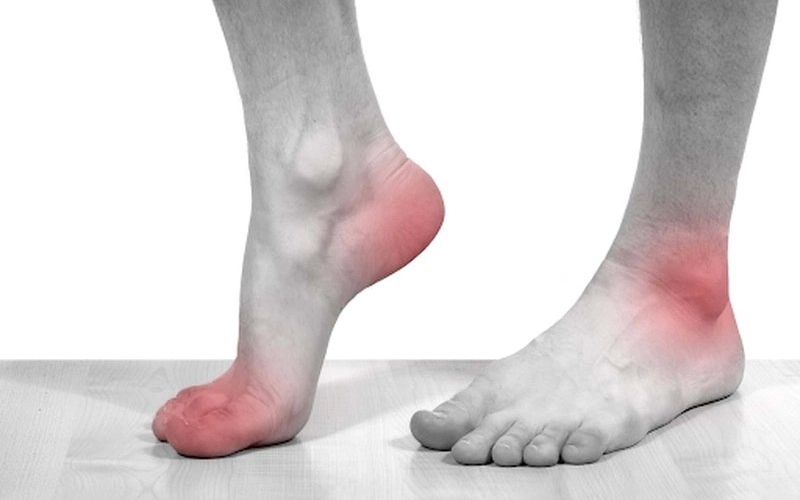Bệnh gout thường xuất hiện đột ngột với những triệu chứng đặc trưng