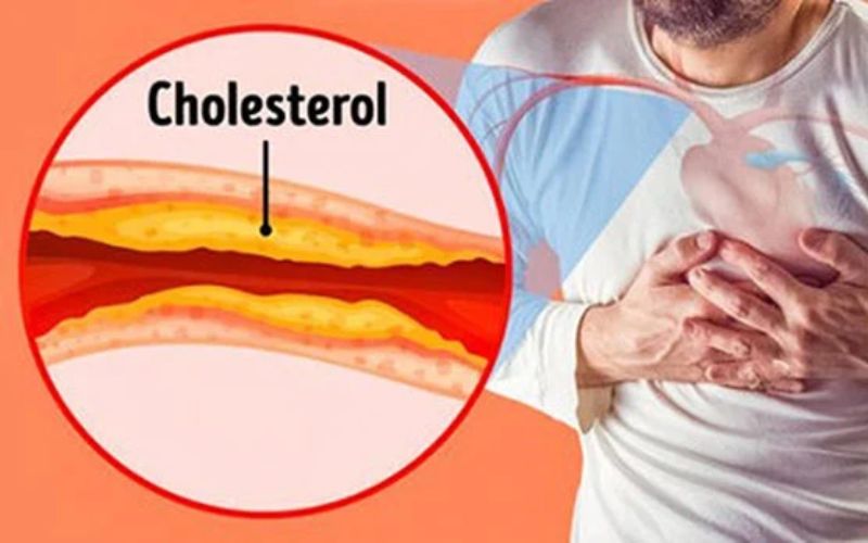 Phương pháp&nbsp;lọc máu xấu giảm mỡ máu&nbsp;này giúp cân bằng mức cholesterol trong cơ thể